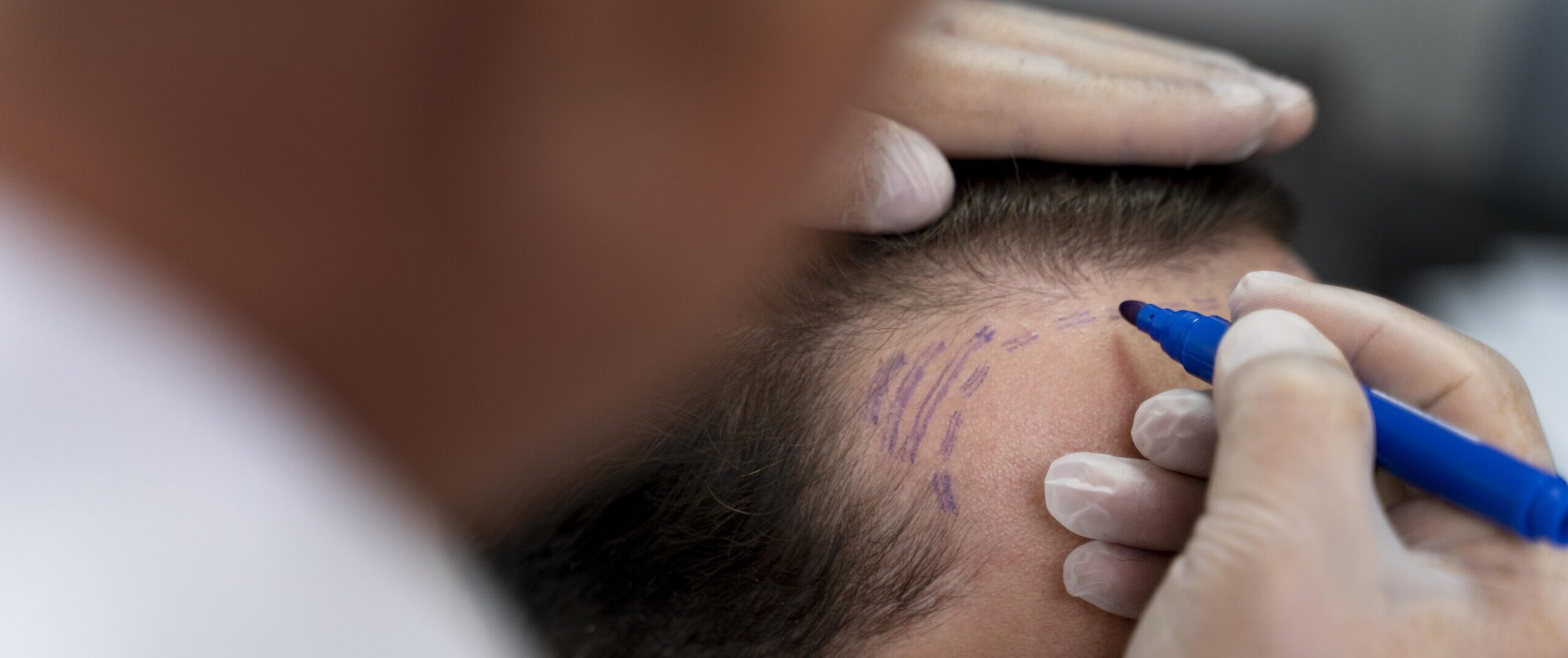 Hair Transplant in Mohali