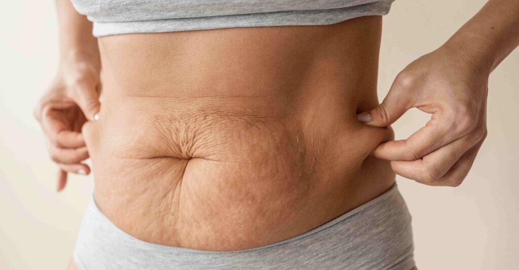 tummy tuck in Mohali