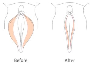 Labiaplasty in Mohali